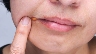 علاج قرحة الفم
