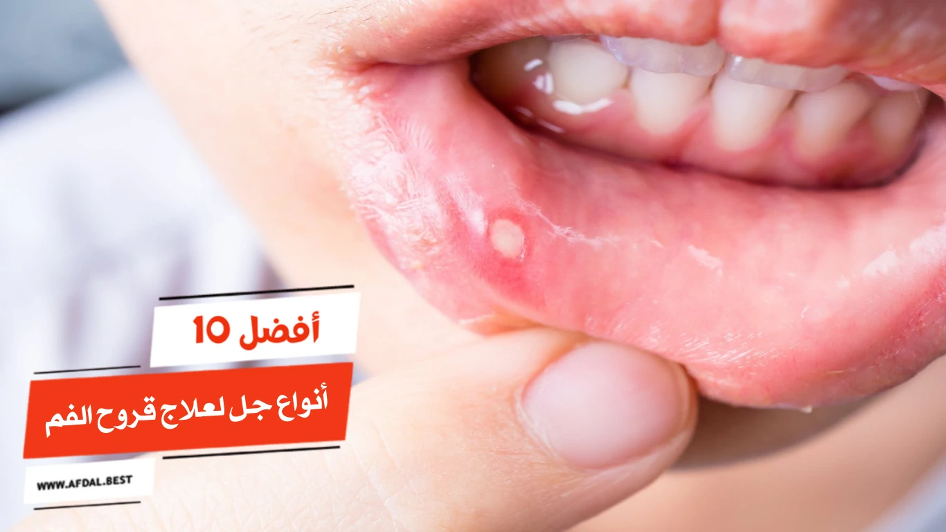 أفضل 10 أنواع جل لعلاج قروح الفم